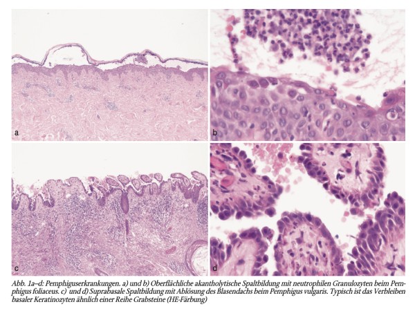 Histologisches Schlaglicht: Akantholyse und akantholytische Dyskeratose