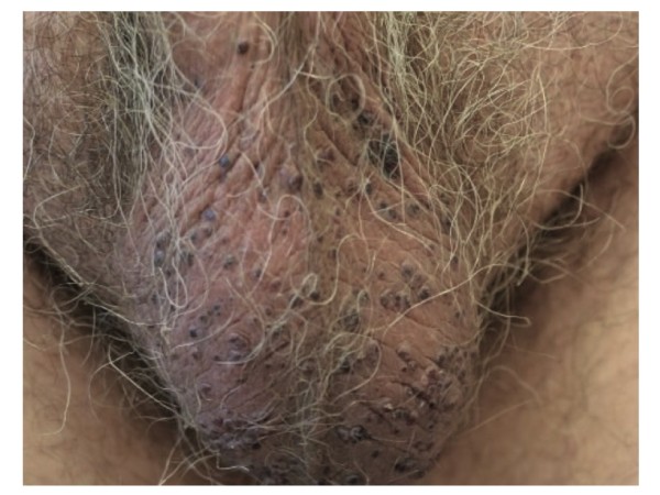 Angiokeratoma scroti (»Angiokeratoma of Fordyce«) – erfolgreiche Therapie durch gepulsten Farbstofflaser und Nd:YAG-Laser