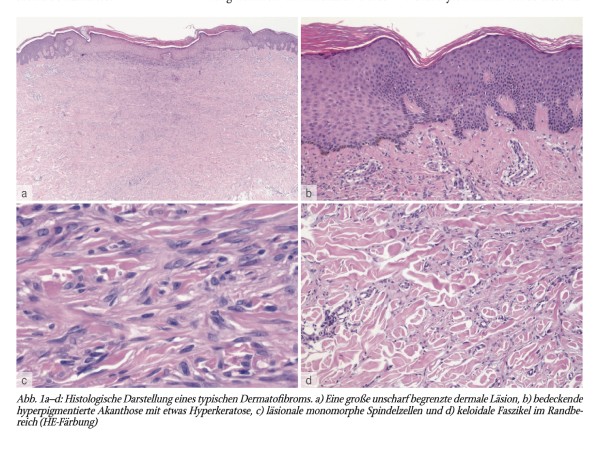 Histologisches Schlaglicht: Dermatofibrom