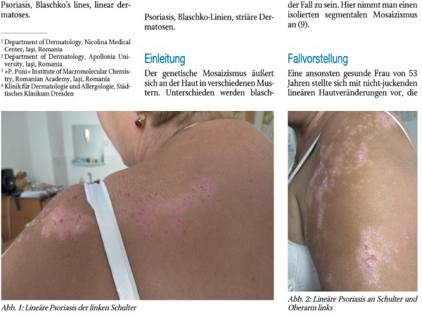 Psoriasis entlang der Blaschko-Linien