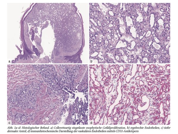 Rezidivierendes Granuloma pyogenicum mit Satellitose