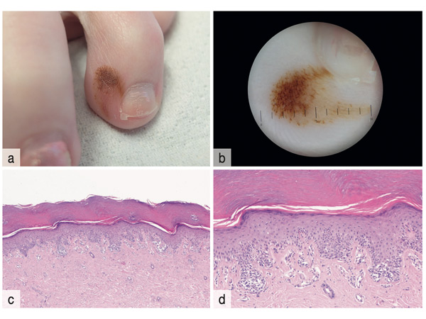 Histologisches Schlaglicht: Melanozytäre Nävi – Teil 2