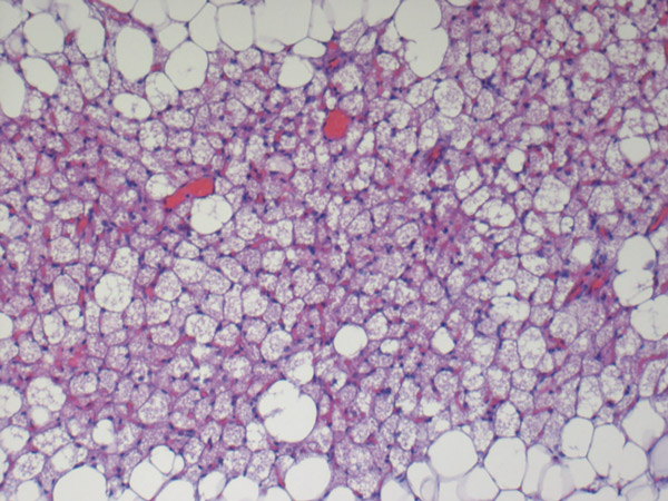 Hibernom – ein seltener Tumor im HNO-Gebiet