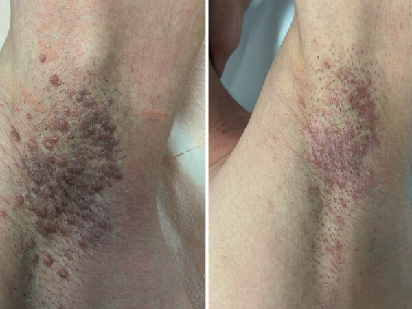 Therapie von eruptiven Syringomen mit dem ablativen Erbium: YAG-Laser