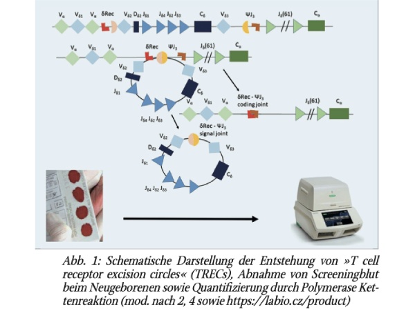 Neugeborenenscreening auf schwere kombinierte Immundefekte