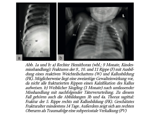 Forensische Pädopathologie: Skelett-Traumata nach Kindesmisshandlung