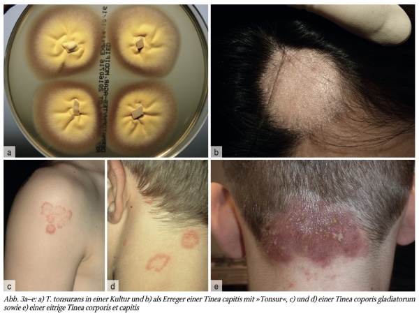 Mykosen bei Kindern – Teil 2: Tinea corporis et capitis