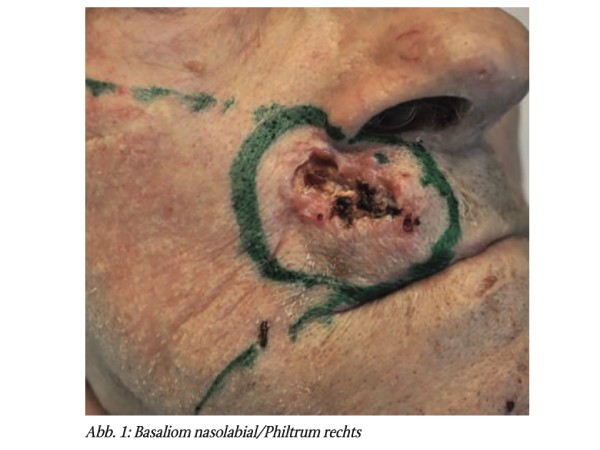 Ausgedehntes Basaliom nasolabial/ Philtrum rechts als operative Herausforderung