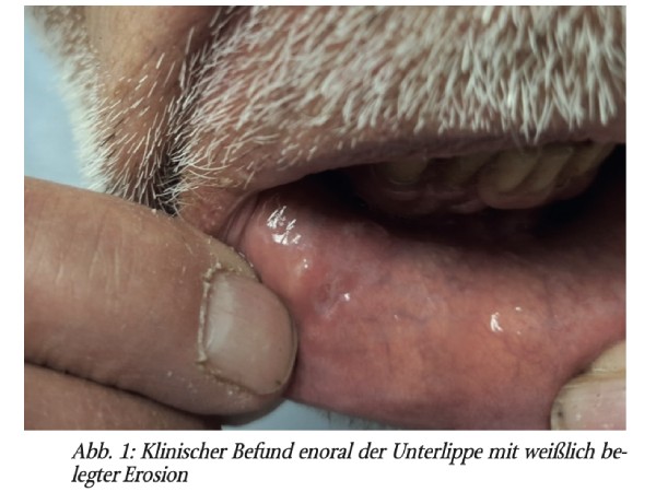 Spätsyphilis unter dem Bild einer Psoriasis